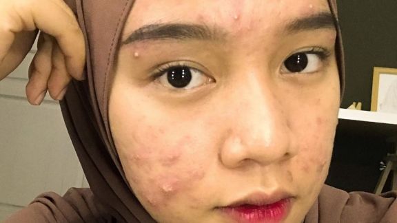 Inspiratif! Novia Nur Ismi Tetap Tampil Pede Meski Jerawat Penuhi Wajahnya