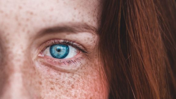 Yuk Ketahui Penyebab Munculnya Freckles pada Kulit Wajah, Ternyata Karena Hal Ini Beauty!
