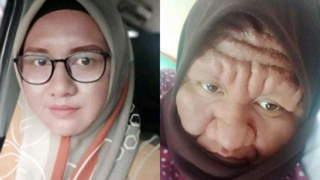 Viral! Wanita Asal Malaysia Ini Alami Perubahan Muka saat Hamil