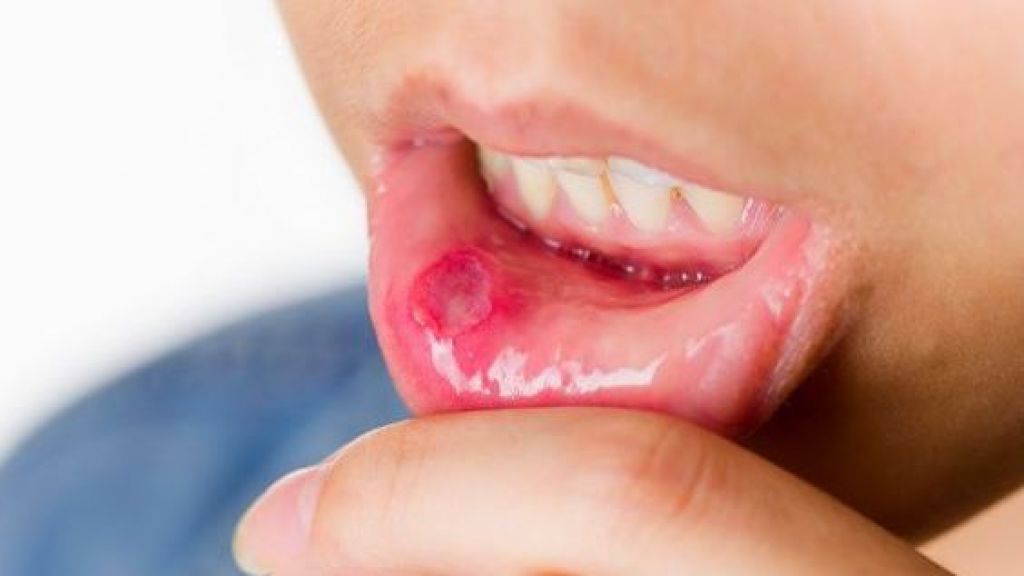 Please Jangan Abai, Ini 10 Tanda ‘Halus’ yang Mengindikasikan Kamu Menggidap Kanker Mulut Beauty!