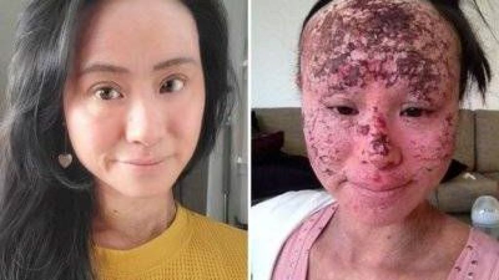 Miris! Seorang Wanita Menggunakan Steroid Berlebihan untuk Mengobati Eczema, Wajahnya Malah Hancur!