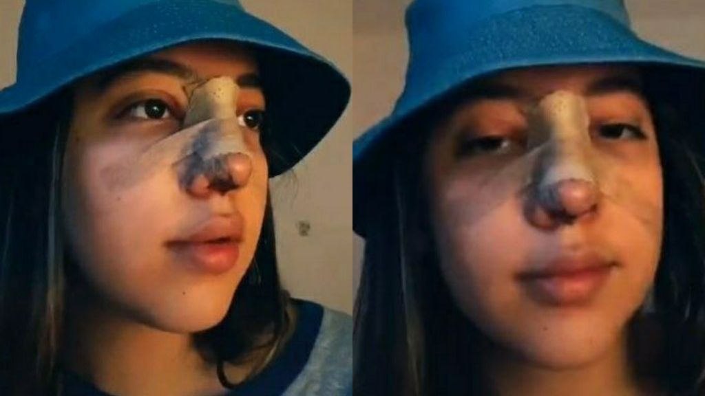 Tak Sabaran Ingin Operasi Hidung, Remaja Ini Dinyatakan Positif Virus Corona