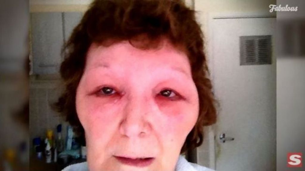 Viral! Kisah Wanita Jadi Korban Suntik Botox Palsu, Wajahnya seperti Monster Frankenstein!