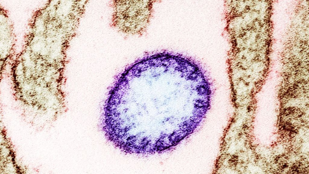 Heboh Virus Nipah, Bisa Bikin Koma dalam Waktu 2 Hari!