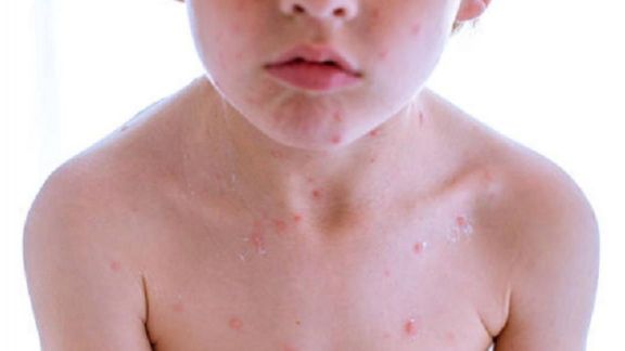 Kenapa Anak Bisa Alami Alergi Susu Sapi? Simak Penjelasan Dokter Ini Yuk Moms!