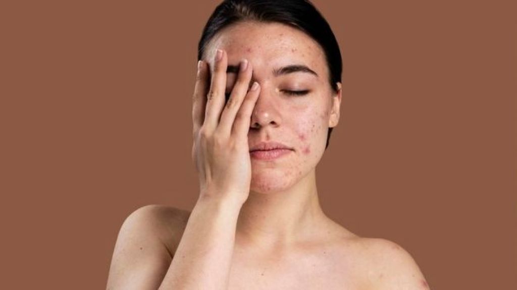 Sulit Hilangkan Noda Bekas Jerawat Membandel? Simak Urutan Skincare yang Gak Boleh Kamu Lewatkan Berikut Ini