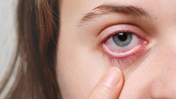 Penyakit Mata Kering Bisa Berakibat Fatal, Yuk Kenali Gejala dan Cara Pengobatannya