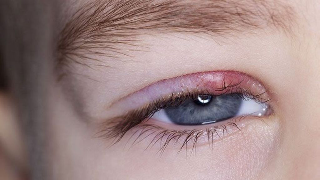5 Komplikasi Penyakit Diabetes yang Terjadi pada Mata