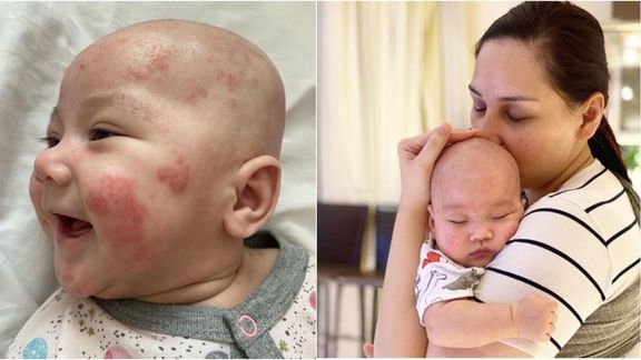 Mengenal Dermatitis Atopi, Penyakit yang Sempat Diderita Bayi Mona Ratuliu, Seperti Apa?