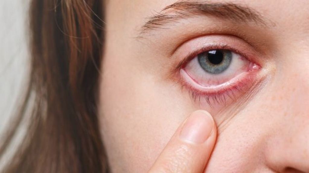 Hati-hati Moms, Ini Penyakit Komplikasi pada Mata Akibat Kolesterol yang Tinggi