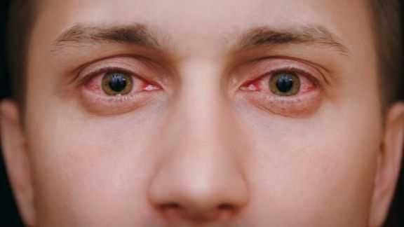 Jangan Anggap Stroke pada Mata Sepele, Dokter Ungkap Bisa Sebabkan Kebutaan