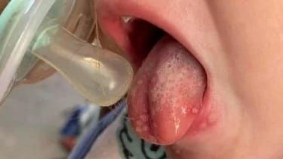 Moms Jangan Biarkan Anak Dicium Sembarangan, Hati-hati Bisa Tularkan Penyakit Herpes