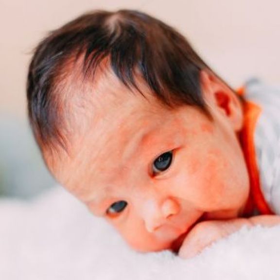 Bayi Timbul Biang Keringat saat Musim Panas? Yuk Kenali Penyebab hingga Cara Mengatasinya Moms!