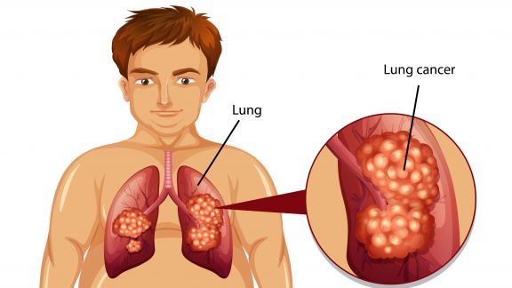 Meresahkan Warga Jakarta, Polusi Udara Picu Kanker Paru-paru Lho Moms, Kenali Penyebab Lainnya yang Gak Banyak Orang Tahu!