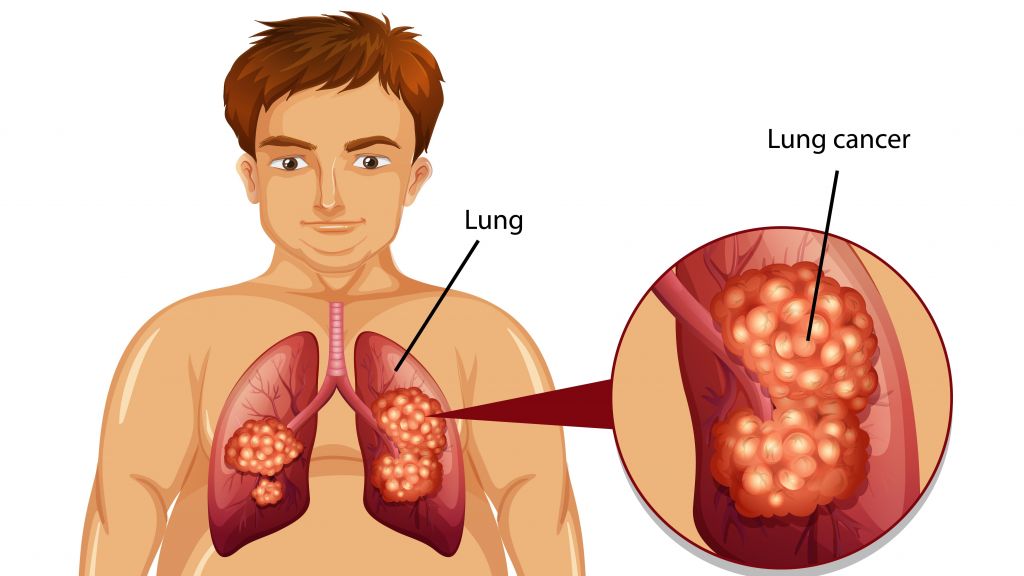 5 Gejala Awal Kanker Paru-paru yang Sering Disepelekan, Nomor 3 Gak Nyangka Banget!