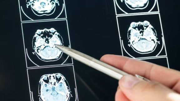 Brain Panel Immunohistochemistry Jadi Solusi Pengobatan Bagi Pasien Tumor Otak