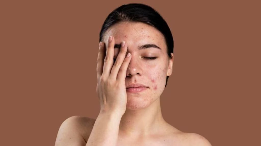 Cuss Coba Beauty! Ini 5 Kandungan Skincare yang Bisa Atasi Wajah Bopeng, Siap Punya Kulit Mulus dan Glowing?!