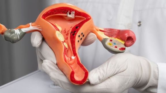 Berkaca pada Kiky Saputri yang Ovariumnya Diangkat karena Kista, Ini Lho Penyebab Kista yang Harus Dihindari