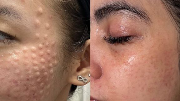 Mengintip Teknologi Skinbooster Minim Rasa Sakit, Bisa Bikin Kamu Cantik Tanpa Menderita!