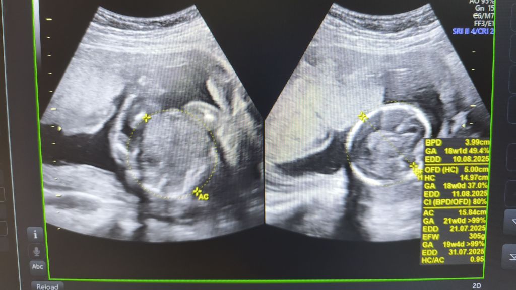 Cerita Pasangan Suami Istri Berhasil Memiliki Momongan dengan IVF Setelah 7 Tahun